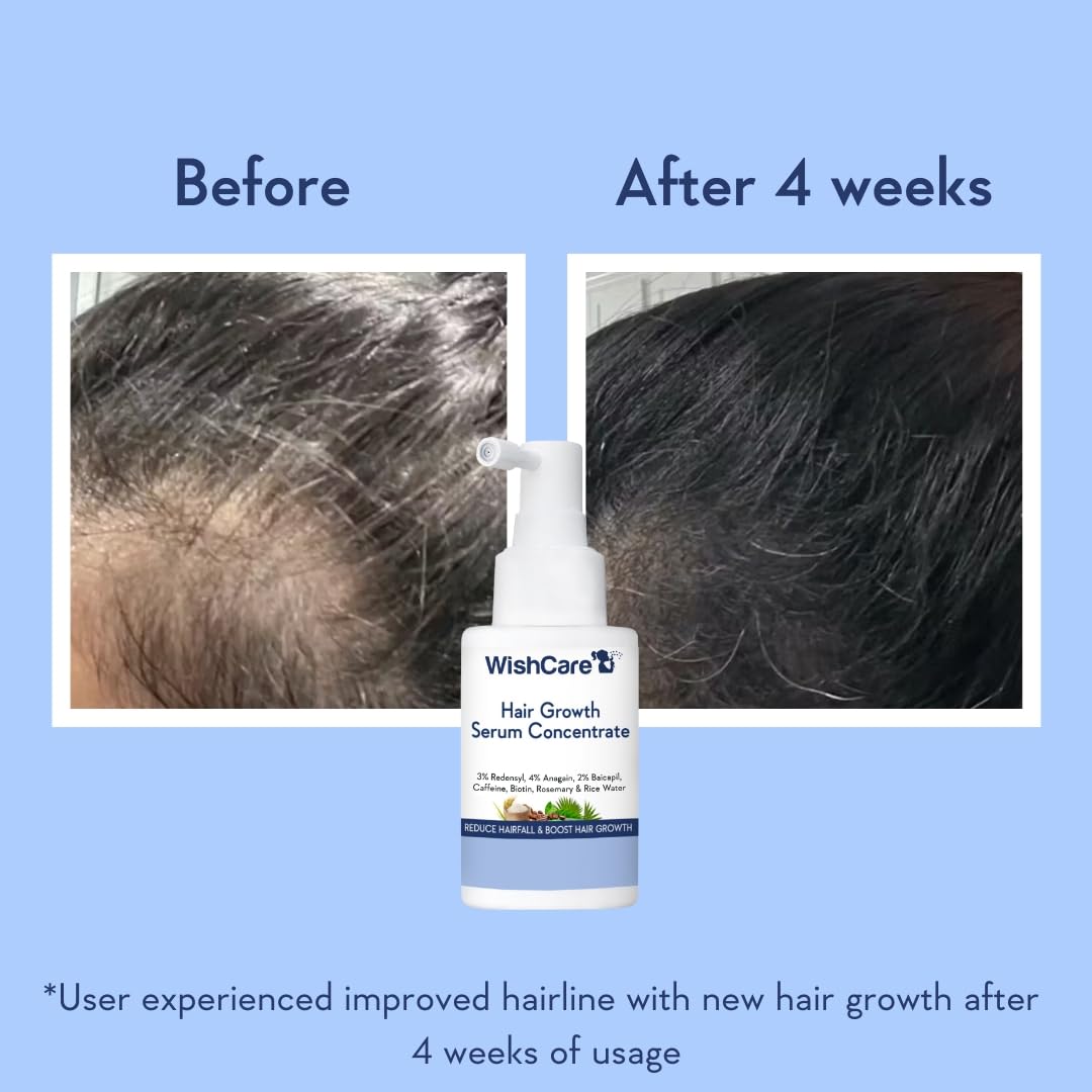 WishCare Hair Growth Serum Concentrate | Redensyl, Anagain & Rosemary | Boosts New Growth & Controls Hairfall | Hair Growth Serum for Scalp | In-Vivo Tested | For Men & Women | 30ml image 5